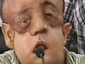 El primer trasplantado total de cara se mostró ante las cámaras