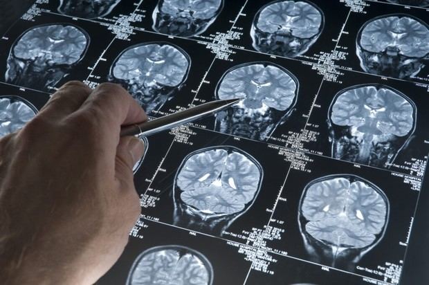 Descubren cómo células meníngeas protegen la salud cerebral